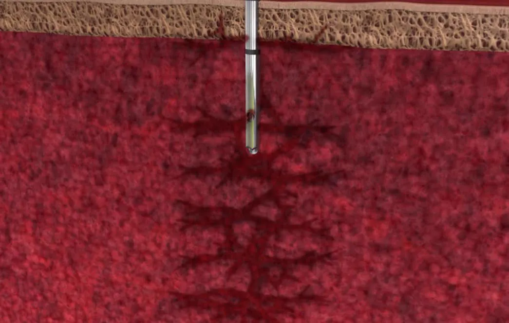 Cervos BMA closed distal tip side-port aspiration