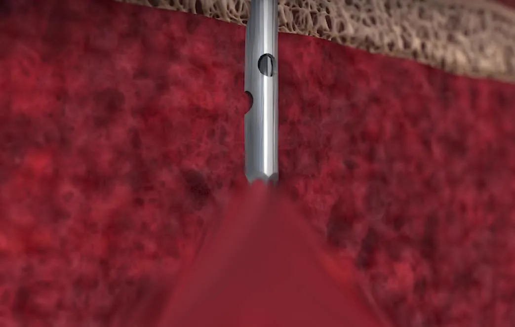 Traditional open-ended trocar needle