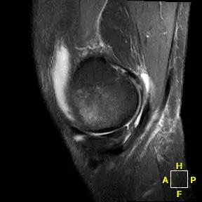 Patient 1 sagittal radiograph, pre-operative