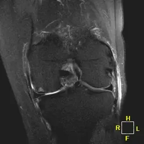 Patient 1 AP radiograph, 3 months post-operative