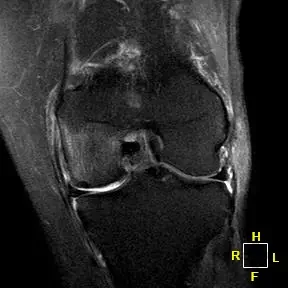 Patient 1 AP radiograph, pre-operative