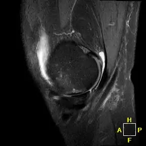 Patient 1 sagittal radiograph, 3 months post-operative