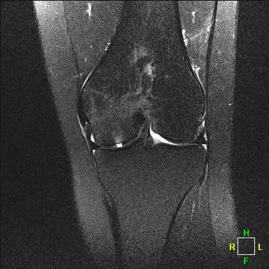 Patient 2 AP radiograph, 3 months post-operative