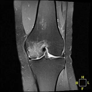 Patient 2 AP radiograph, pre-operative