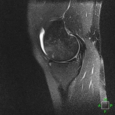 Patient 2 sagittal radiograph, 1 month post-operative