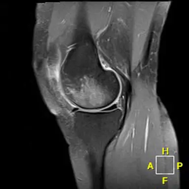 Patient 2 sagittal radiograph, pre-operative